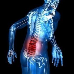Osteochondrozė