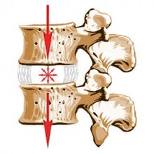 Stuburo prietaisas ir osteochondrozės priežastys