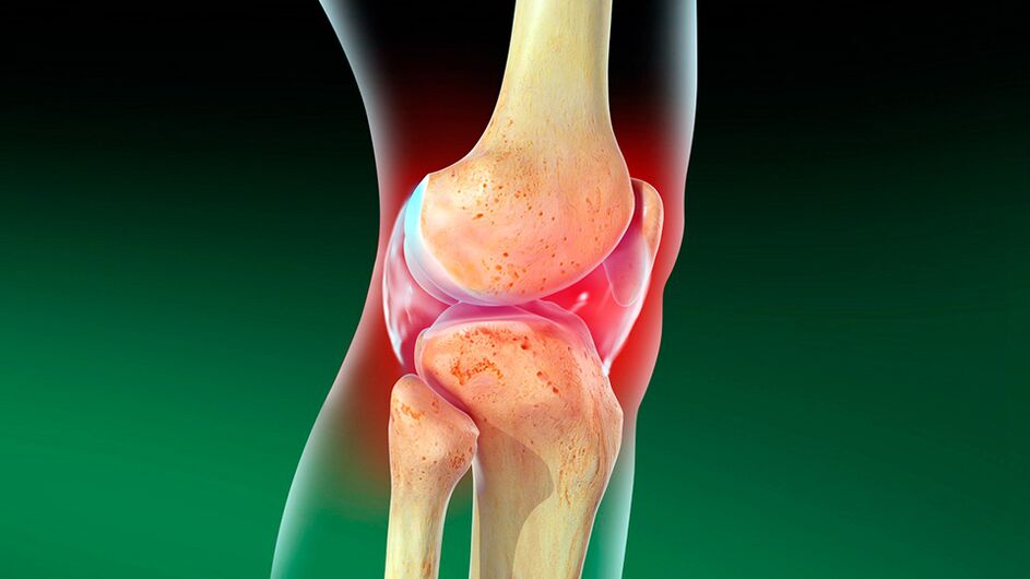 Kelio sąnario osteoartritas